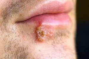 болячки на губе