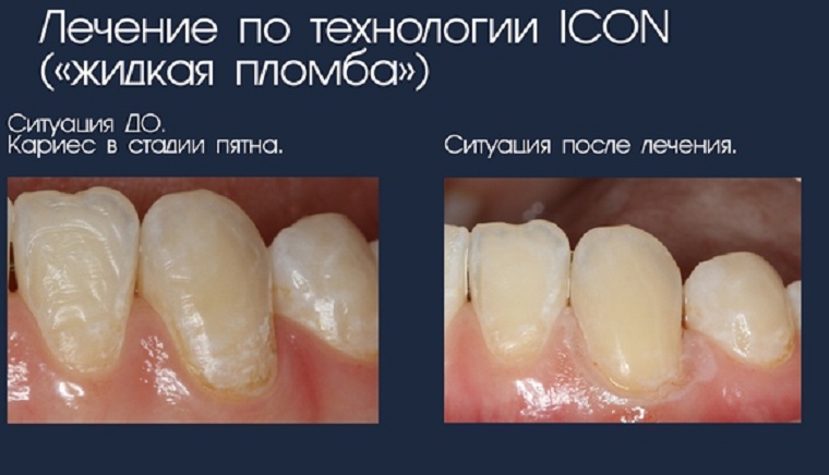 До и после лечения Icon