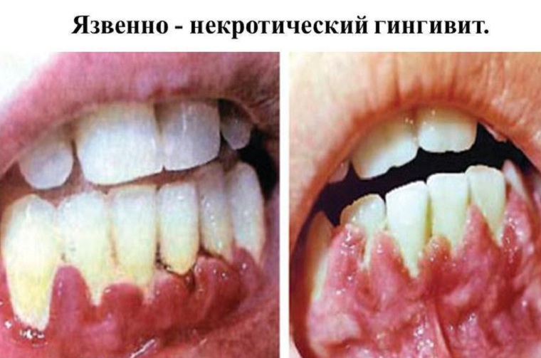 язвенные десна