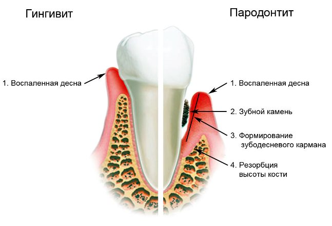 схема развития гингивита и пародонтита