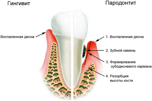 Гингивит и пародрнтит