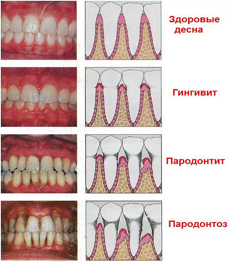 причины красных десен у детей