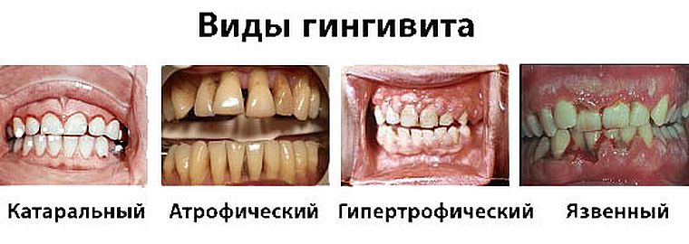 виды гингивита