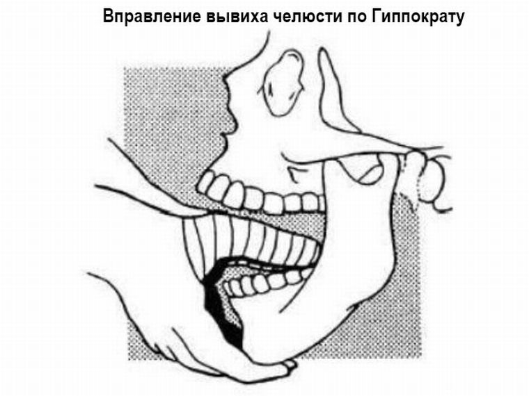 Метод Гиппократа