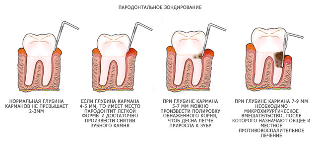 глубина пародонтального кармана