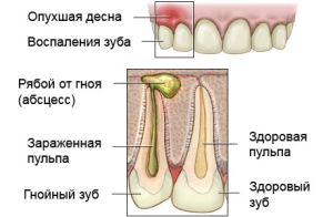 гнилой зуб