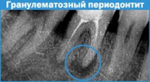 гранулематозный периодонтит на рентгене