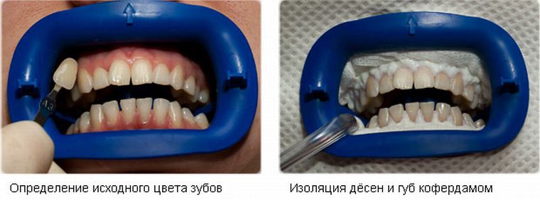 процедура отбеливания