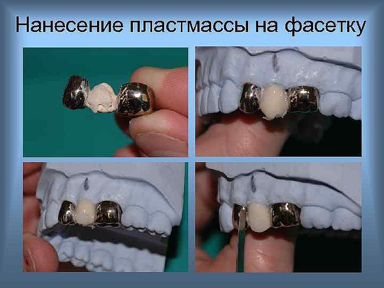 нанесение пластмассы