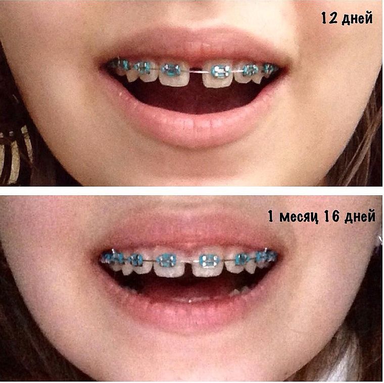 лечение диастемы брекетами