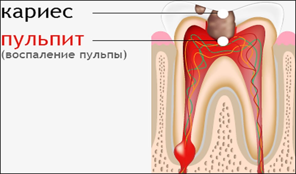 Воспаление пульпы