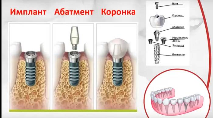 винтовой имплантат
