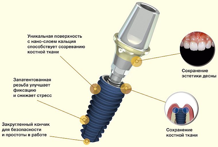 AnyOne импланты