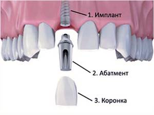 Имплантат