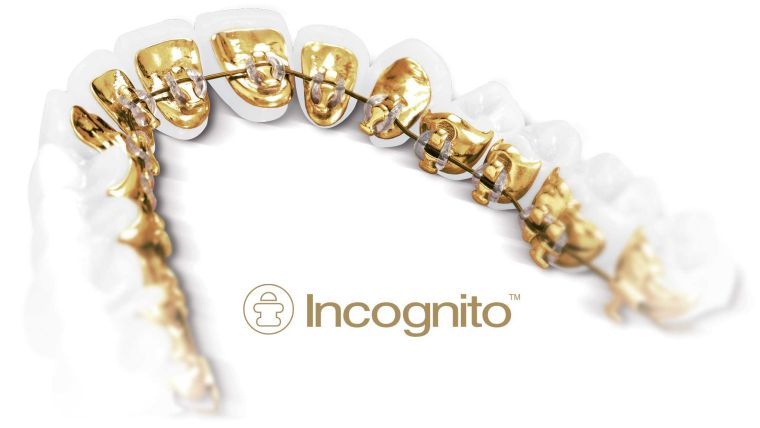 Лингвальные брекеты incognito