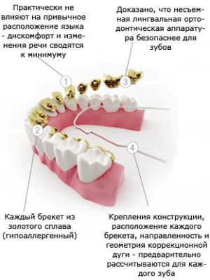 лингвальные брекеты