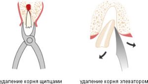 инструмент для удаления