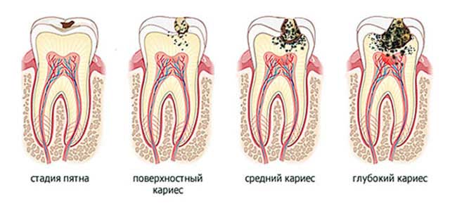 Срединный кариес