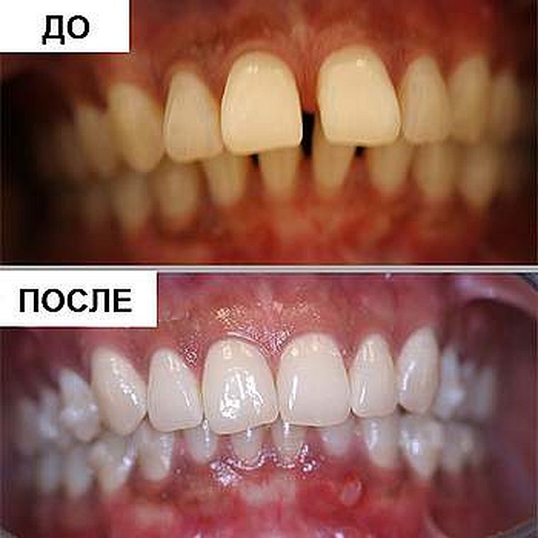капы для лечения диастемы