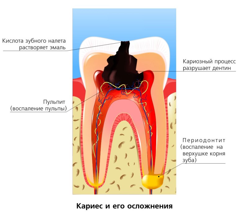 кариес