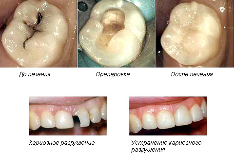 лечение среднего кариеса