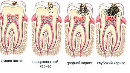 стадии кариеса