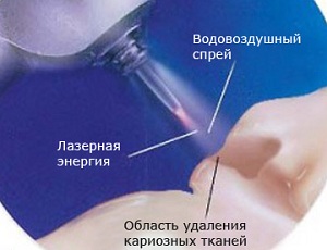 терапия кариеса
