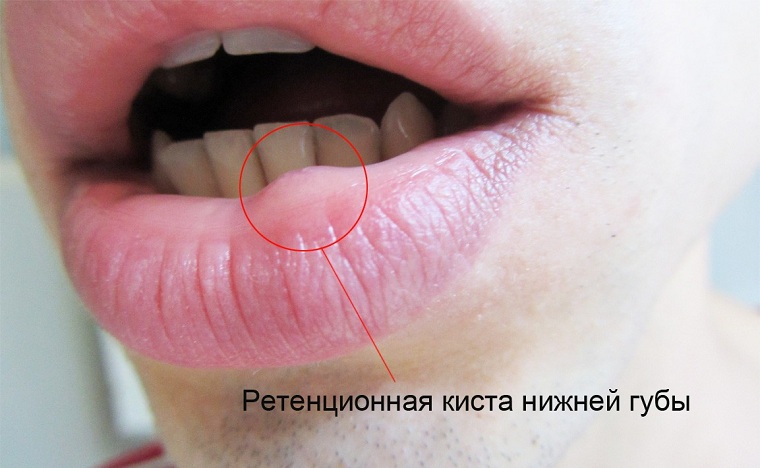 ретенционная киста нижней губы