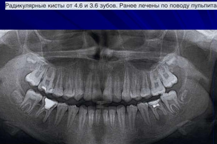 радикулярная киста