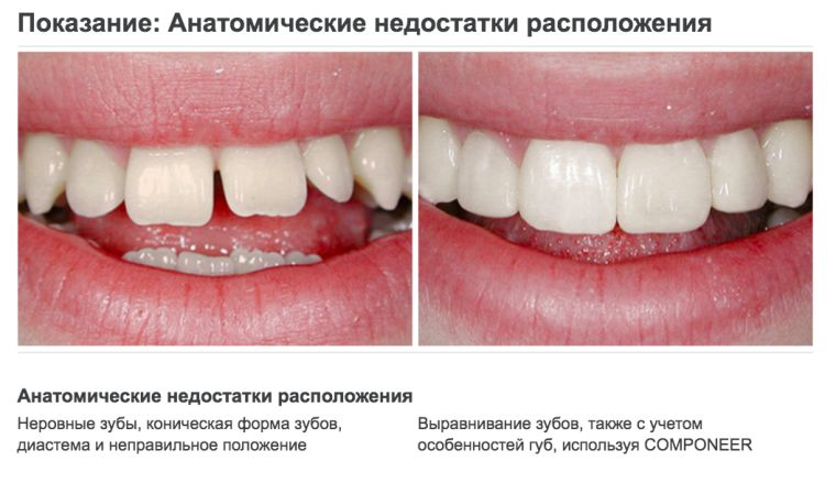 Коррекция компонирами