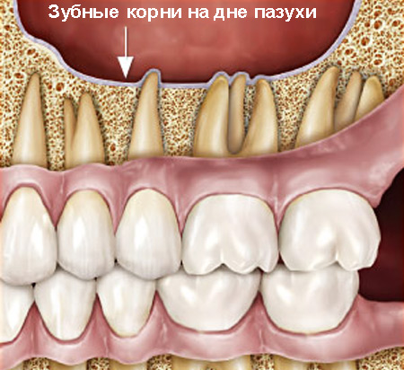 Корни зубов на дне пазухи