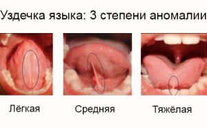 степени короткой уздечки