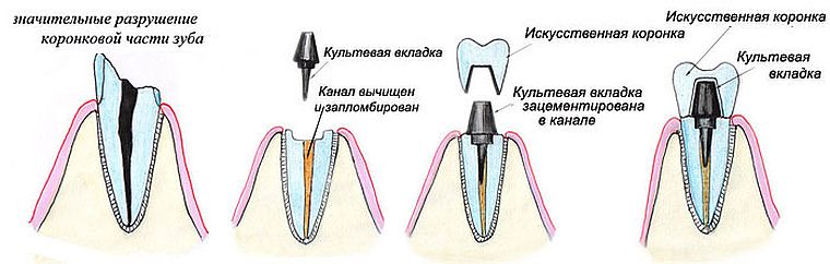 культевые вкладки