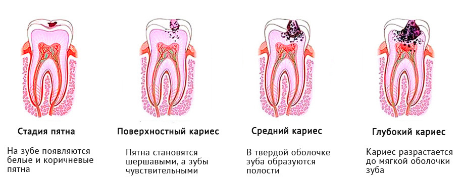 Кариес