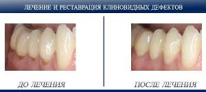 лечение клиновидного дефекта