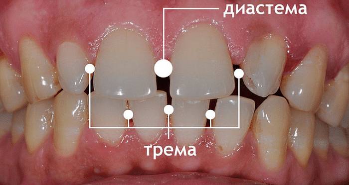 отличие диастемы от тремы