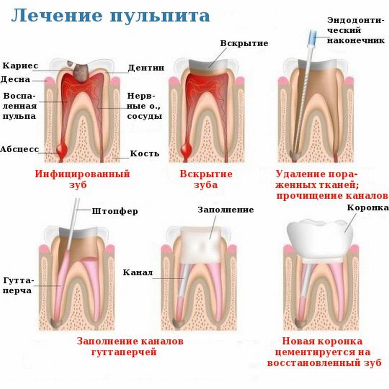 лечение пульпита