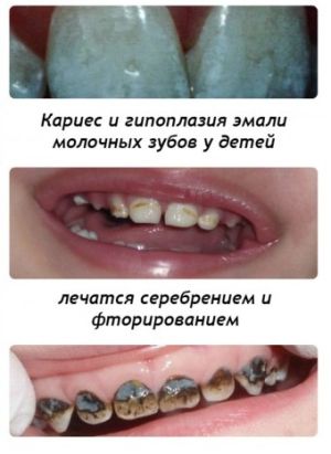 разрушение зубной эмали у детей