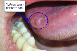 лейкоплакия