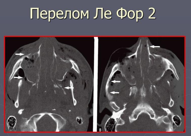 Перелом по Лефору 2