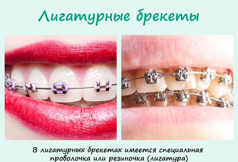 Лигатурные брекеты