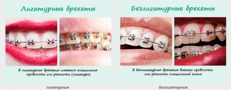лигатурные и безлигатурные