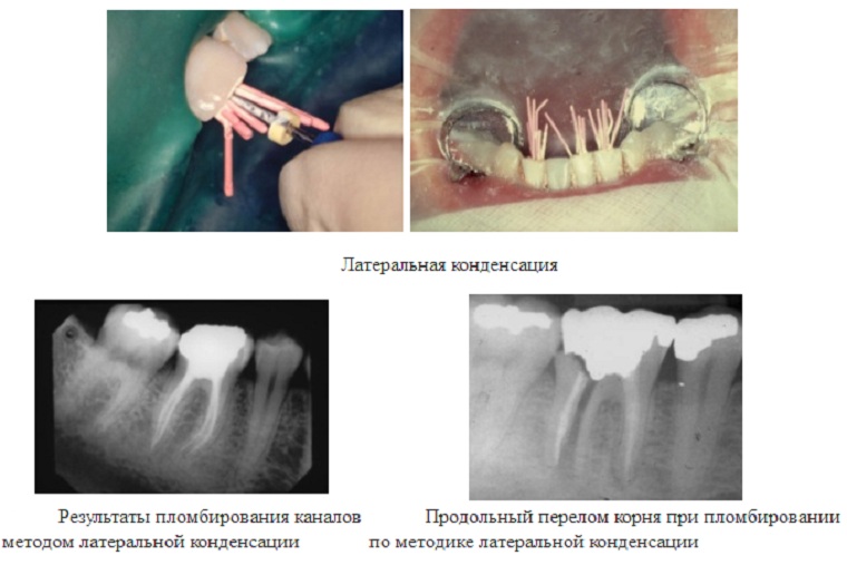 Латеральная конденсация