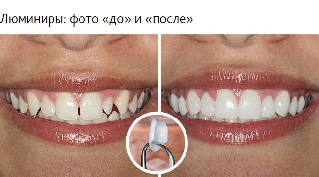 люминиры до и после
