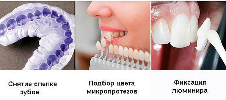ламинирование люминирами