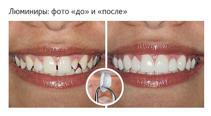 лечение щербинки люминирами