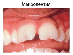 макродентия