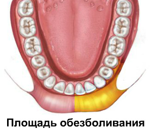 Площадь обезболивания