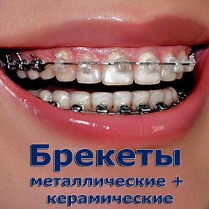 Комбинация брекетов