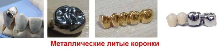 Металлические коронки